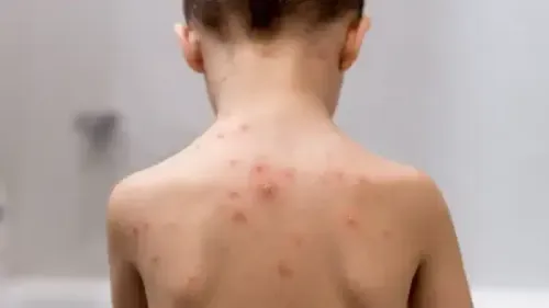 What to Eat When You Have Chickenpox?